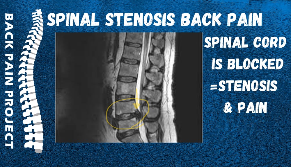 spinal stenosis back pain - The Back Pain Project