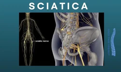 Sciatica Back Pain Relief The Back Pain Project Stamford Darien Norwalk, New Canaan 203-656-3638