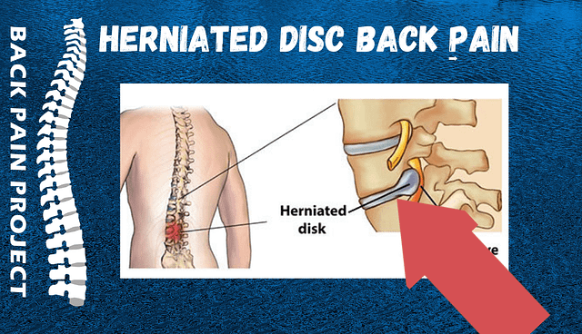 herniated disc back pain The Back Pain Project 203-656-3638 Darien New Canaan