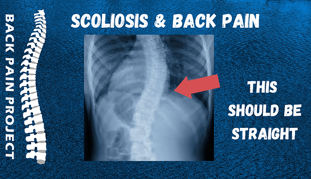 The Back Pain Project Stamford Darien Norwalk New Canaan treats scoliosis-related back pain darien norwalk new canaan stamford