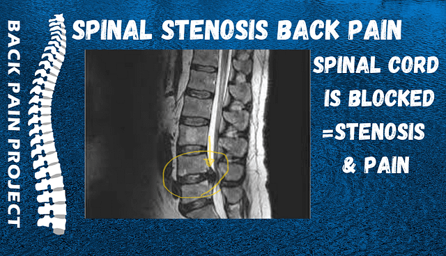 The Back Pain project Stamford Darien Norwalk New Canaan treats Spinal Stenosis Back Pain