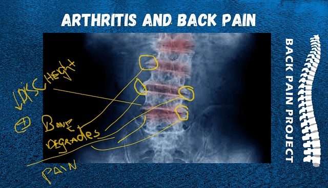 The Back Pain project Stamford Darien Norwalk New Canaan treats arthritis-related back pain