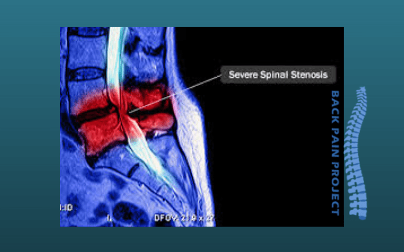 spinal stenosis back pain the Back Pain Project