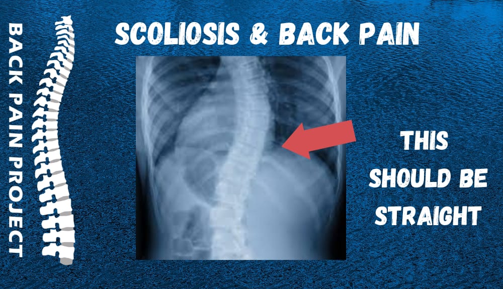 Scoliosis Back Pain - The Back Pain Project