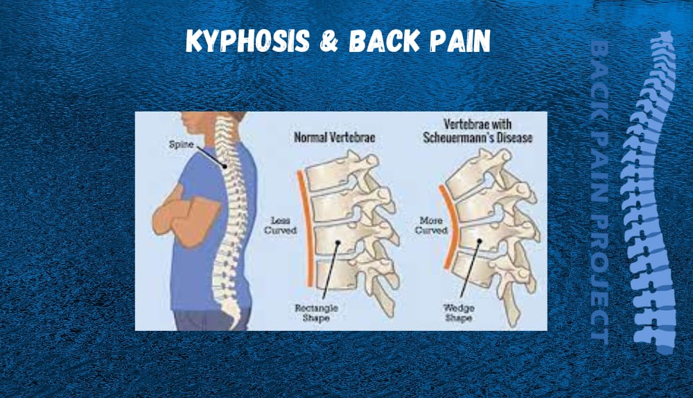 Kyphosis Back Pain The Back Pain Project Darien CT - The Back Pain Project